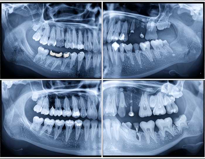 İmplant mı, Köprü mü? - En Doğru Tercih Hangisi? 3 implant diş ve köprü arasındaki farklar