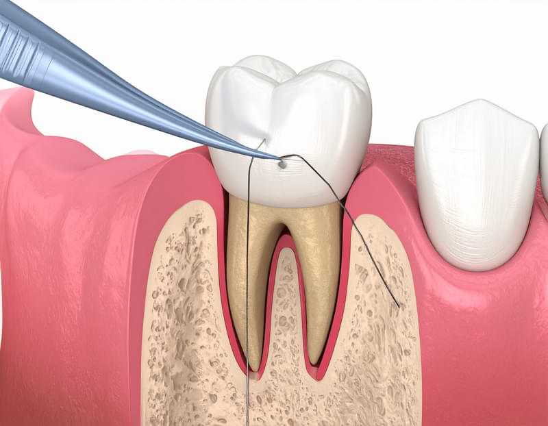 Apikal Rezeksiyon ameliyatı
