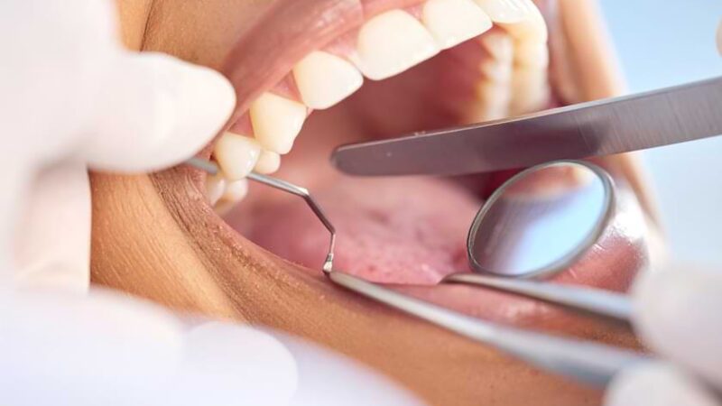 Diş Çekimi Sonrası Kanama