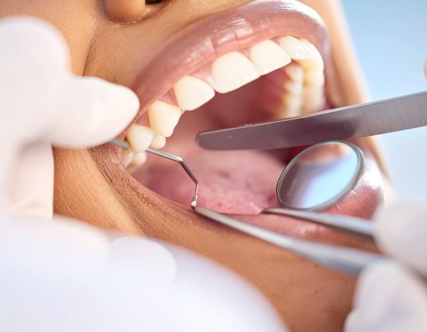 Diş Çekimi Sonrası Kanama